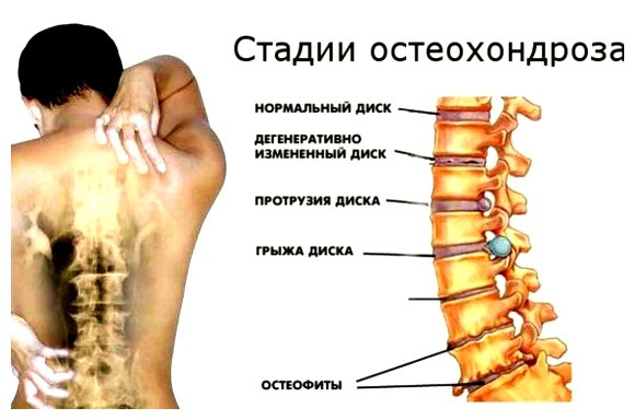 Остеохондроз грудного отдела позвоночника, симптомы и лечение